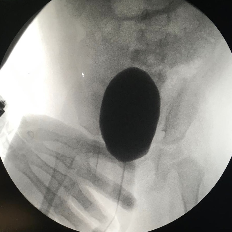 Technologist's hand captured in the direct x-ray beam during a voiding cystourethrogram.