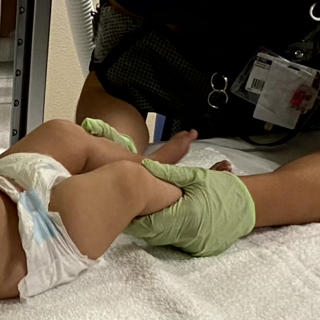 Manually holding an infant by the legs during a voiding cystourethrogram. This technique can lead to bruising and discomfort, highlighting the need for more gentle and secure positioning methods.